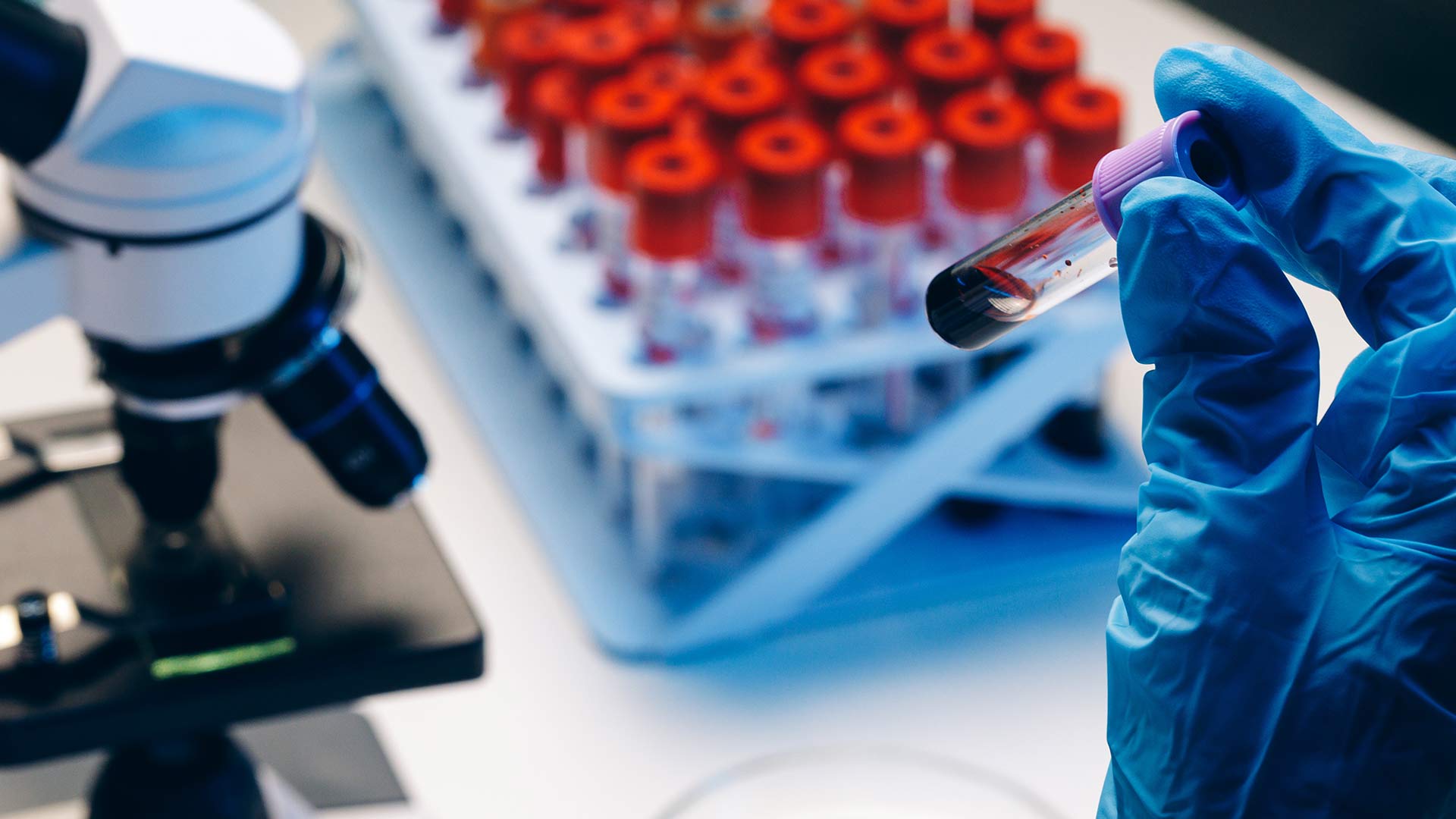 Blue-gloved hand holding a blood sample vial in a lab, illustrating an amyloid test for Alzheimer’s