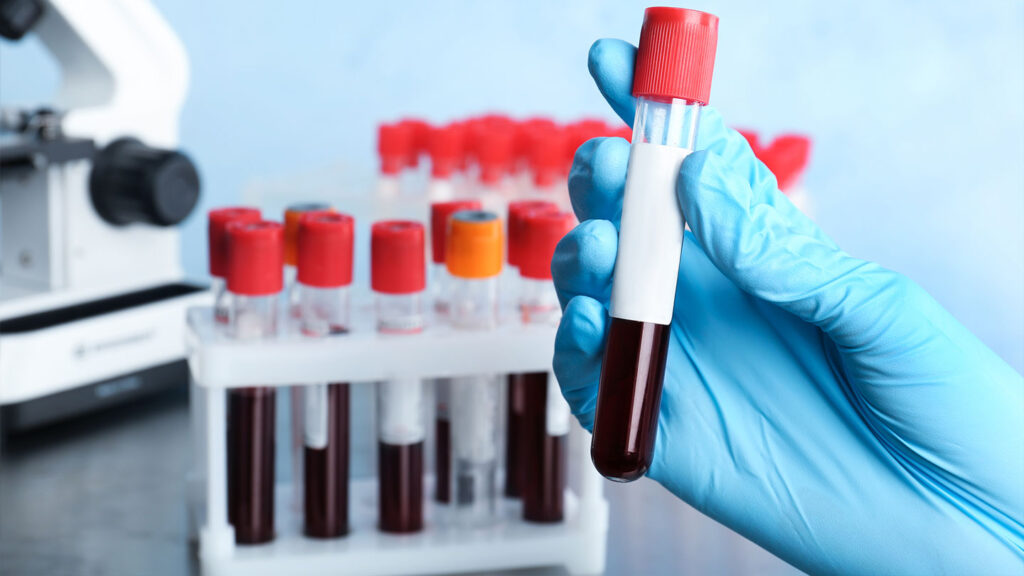 Blue-gloved hand holding a blood sample tube, illustrating LDL under 70 targets and the cardiology pipeline under guideline pressure